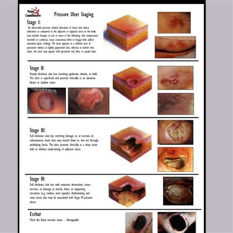 Chart Pressure Ulcer Staging Guide