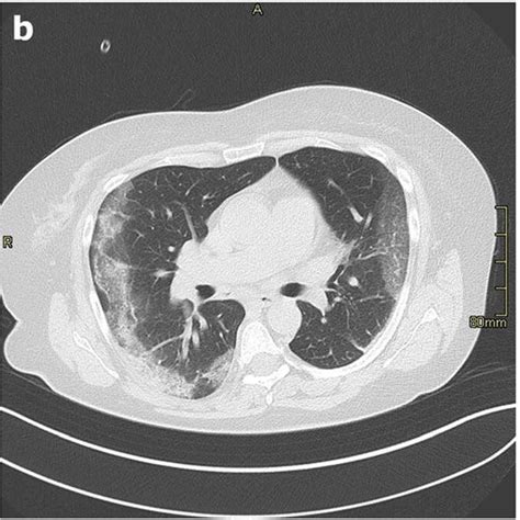 A B Axial Hrct Images Of Two Patient With Acute Eosinophilic Pneumonia