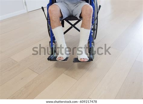 Man Broken Legs Cast Wheelchair Stock Photo 609217478 Shutterstock