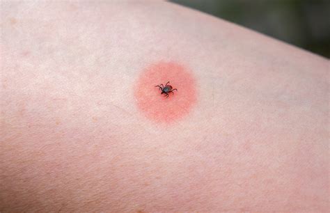 Poisonous Ticks Bites