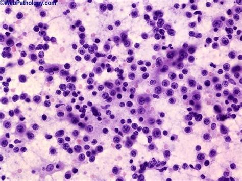 Plasmacytoma Pictures Photos