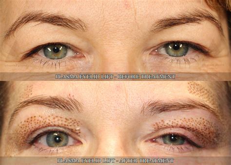 Plasma Eyelid Lift Treatment Before After Pictures More Info