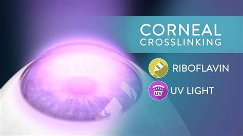 Corneal Cross Linking Ayrshire Eye Clinic