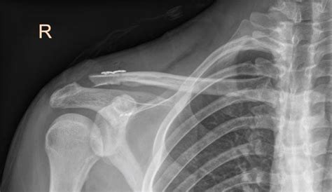Ac Joint Reconstruction Ac Joint Injury Orthopaedic Shoulder Surgeon Perth