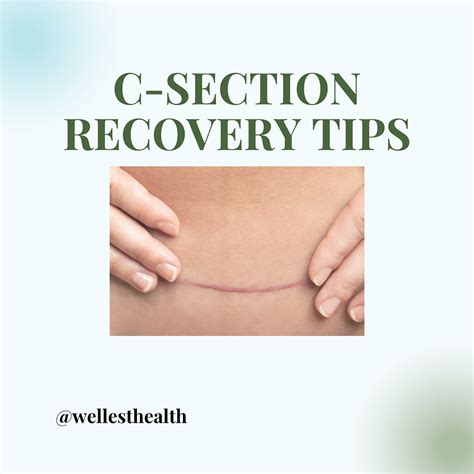 C Section Recovery Tips Wellest Health Pelvic Floor Physical Therapy