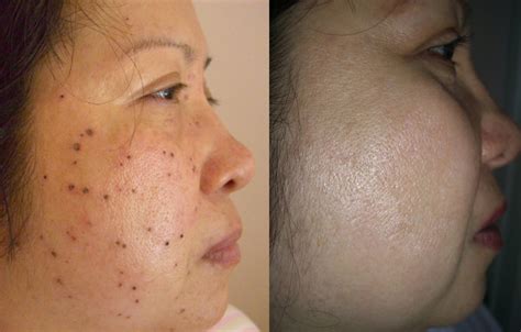 Skin Blemish Removal The Spa Lounge