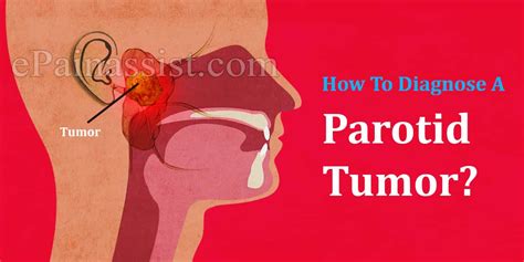 How To Diagnose A Parotid Tumor And What Is The Best Medicine For It