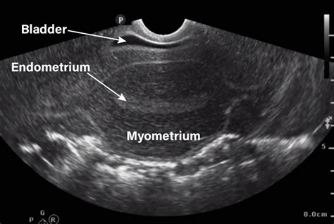 Learn To Use Gynecologypelvic Ultrasound To Identify Indications For