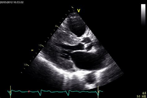 Parasternal Long Axis Echo Image Showing Severe Concentric Left