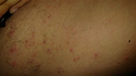 Heat Rash Inner Thighs