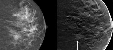 Six Questions To Ask About Mammograms Duke Health
