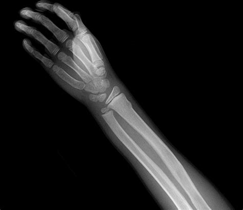 Axillary Nerve Block May Be Effective For Closed Distal Radius Fracture
