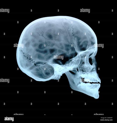 Cráneo Del Niño Vista Lateral De Rayos X Que Muestra El Cráneo Ojo
