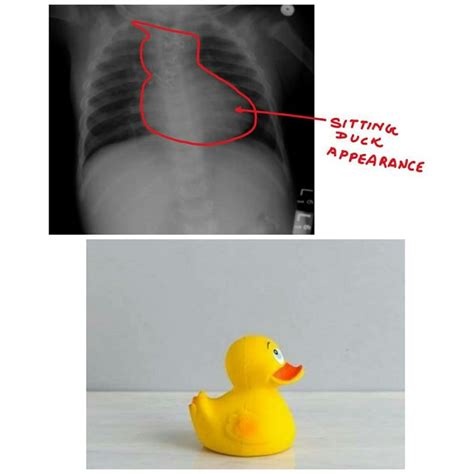 Sitting Duck Appearence Seen In Medizzy