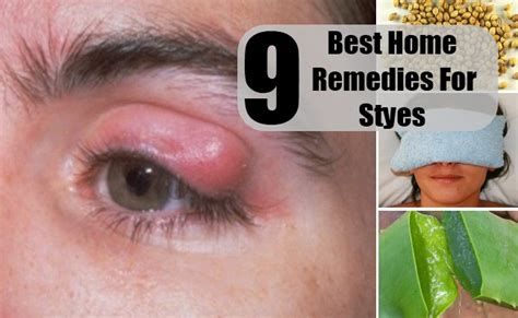 9 Best Home Remedies For Styes Natural Cure And Herbal Treatment For