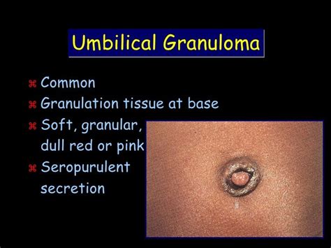 Umbilical Twine Granulation Tissue