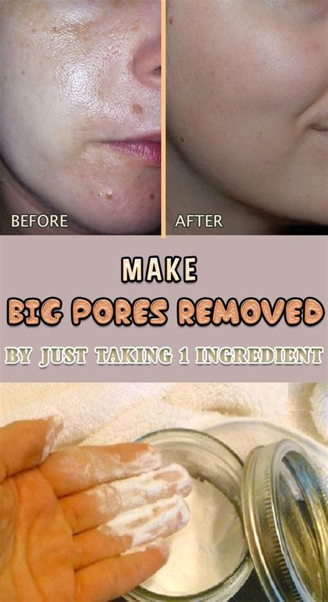 How To Get Rid Of Large Pores Just By Using 1 Ingredient Beauty Top