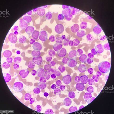 Leukemia Blood Picture Find With Microscope 1000x Stock Photo