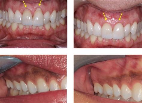 Laser Gum Treatment Morgan And Lemke Periodontics And Dental Implants