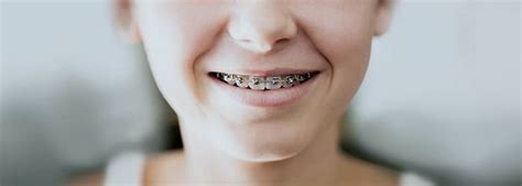 Patients who comply with elastics, drastically reduce treatment time. Kondorossy Dental: Braces: How Braces Work, Pain Relief ...