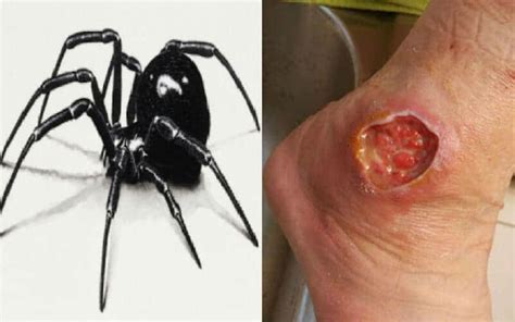 The spider produces a neurotoxic protein that is extremely potent. Black Widow Bite - Causes Symptoms Treatments & Important ...