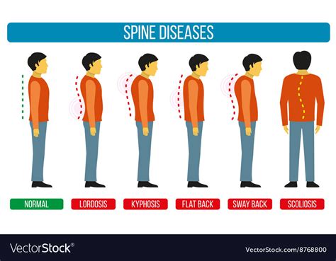 Body Posture Defect Infographics Of Spine Vector Image