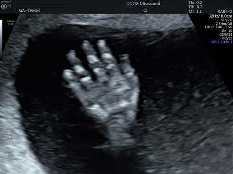 19 Week Scan Perth Mid Trimester Ultrasound Pregnancy Scan Perth