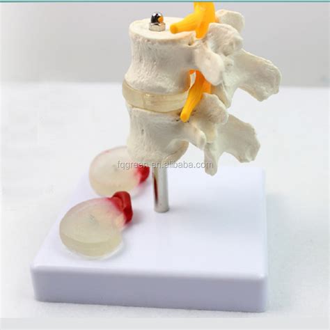 Lumbar Disc Herniation Model Buy Human Anatomical Lumbar Disc