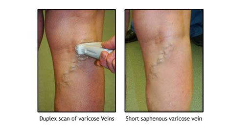 What Are Varicose Veins Jersey Veins Clinic Jersey