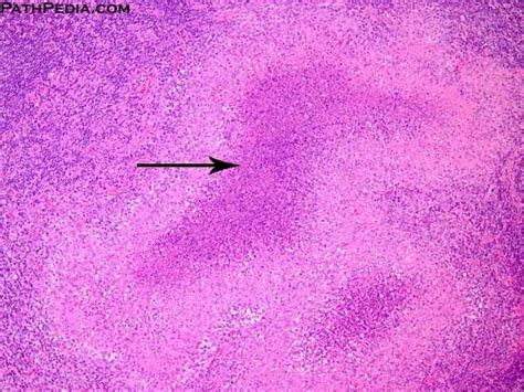 Histopathology Images Of Cat Scratch Disease By