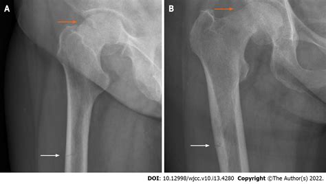 Femoral Neck Fracture X Ray