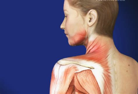 Myofascial Pain Syndrome And Fibromyalgia Ahealthguide