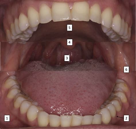 References In Benign Oral Mucosal Lesions Clinical And Pathological Findings Journal Of The