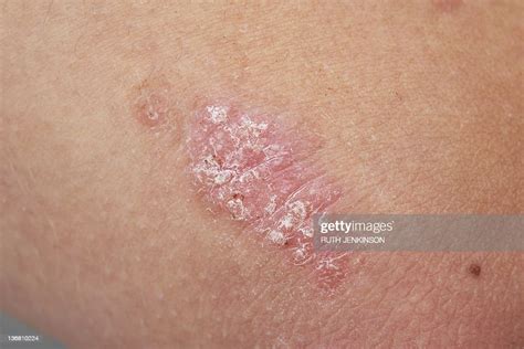 Psoriasis High Res Stock Photo Getty Images