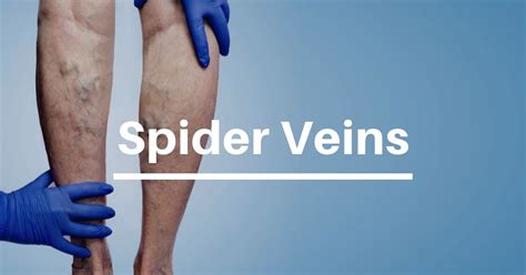 Best Varicose Vein And Spider Vein Treatment Fsa Vein