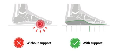 Metatarsalgia What It Is Causes And How Insoles With Metatarsal Pads Offer Relief The