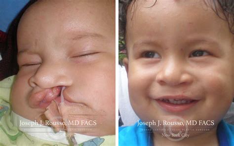 Cleft Lip And Palate Surgery For Children New York Ny