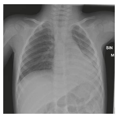 Chest X Ray At Arrival Showing Infiltrates Andor Atelectasis In The