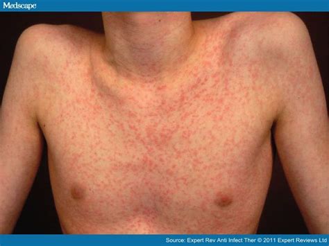 17 Best Images About Drug Allergy On Pinterest Severe Allergy