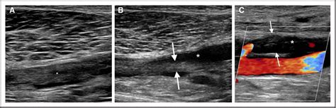 Figure 3 From Ultrasound For Lower Extremity Deep Venous Thrombosis