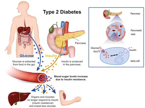 Timely Insulin Therapy To Treat Type 2 Diabetes Research Outreach