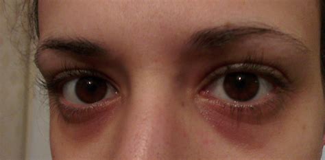 So My Eyes Always Look Tired Im Fed Up Ive Tried So Many Different Creams And Treatments