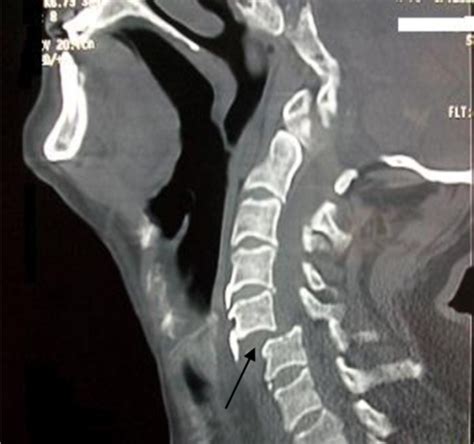 Ct Scan Of Cervical Spine Revealing Partial Anterior Su Open I