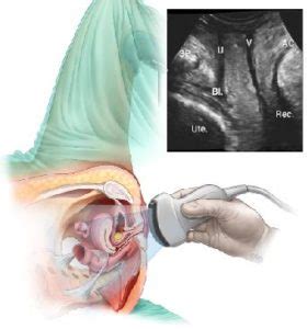 How to transabdominal view of the female pelvis with ultrasound spanish. Transperineal Pelvic Floor Ultrasound Scan - Your Pelvic Floor