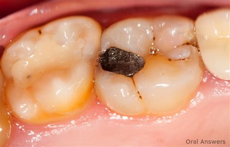 What Do Silver And White Fillings Look Like Oral Answers