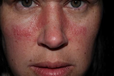 Rash On Face Only Pictures Photos