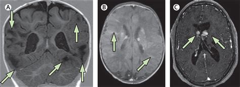 Neurological And Neuropsychiatric Aspects Of Tuberous Sclerosis Complex