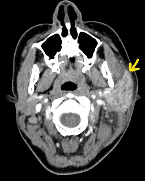 Parotid Gland Swelling Mumps