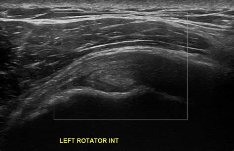Shoulder Ultrasound Diagnostic Imaging Melbourne Radiology