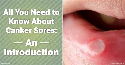 All You Need To Know About Canker Sores An Introduction